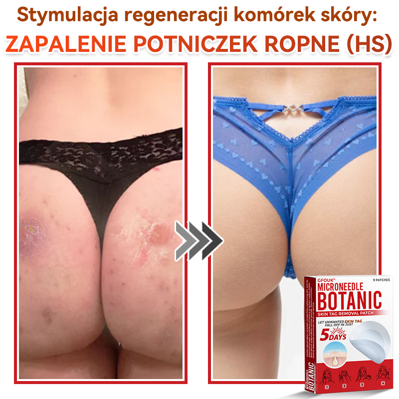 🎁 Zostało już tylko 5 opakowań! Teraz możesz otrzymać dodatkowe 50% ZNIŻKI!  Pomaga widocznie zmniejszyć włókniaki, brodawki i inne niedoskonałości skóry — szybko, wygodnie i bez bólu. 🌿