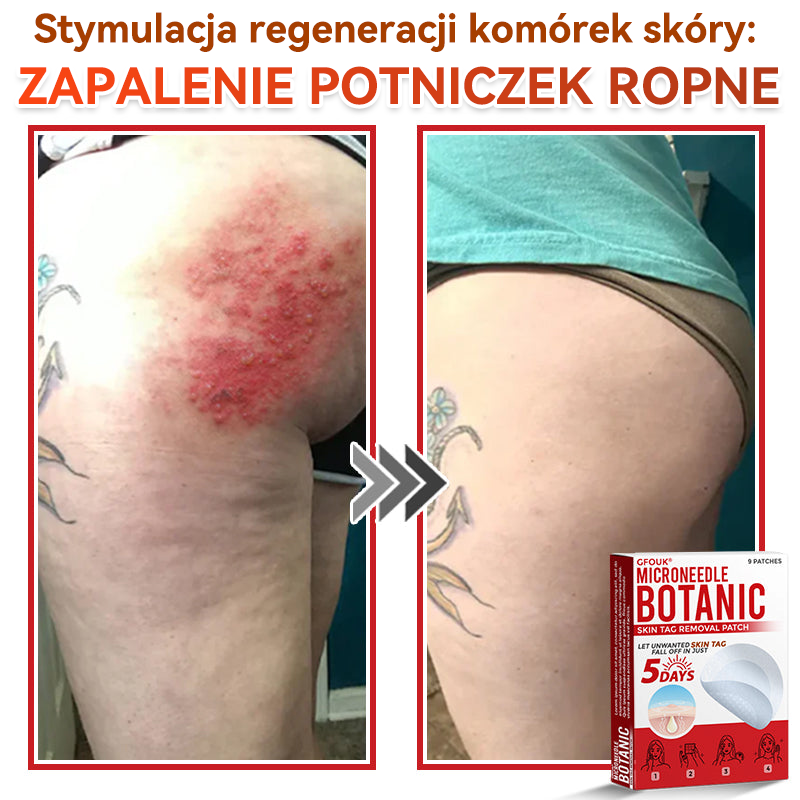 🎁 Zostało już tylko 5 opakowań! Teraz możesz otrzymać dodatkowe 50% ZNIŻKI!  Pomaga widocznie zmniejszyć włókniaki, brodawki i inne niedoskonałości skóry — szybko, wygodnie i bez bólu. 🌿
