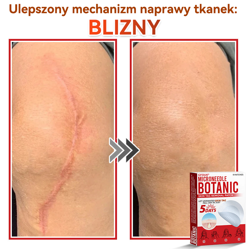 🎁 Zostało już tylko 5 opakowań! Teraz możesz otrzymać dodatkowe 50% ZNIŻKI!  Pomaga widocznie zmniejszyć włókniaki, brodawki i inne niedoskonałości skóry — szybko, wygodnie i bez bólu. 🌿