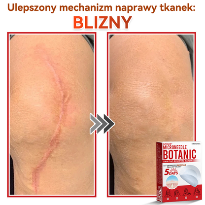 🎁 Zostało już tylko 5 opakowań! Teraz możesz otrzymać dodatkowe 50% ZNIŻKI!  Pomaga widocznie zmniejszyć włókniaki, brodawki i inne niedoskonałości skóry — szybko, wygodnie i bez bólu. 🌿