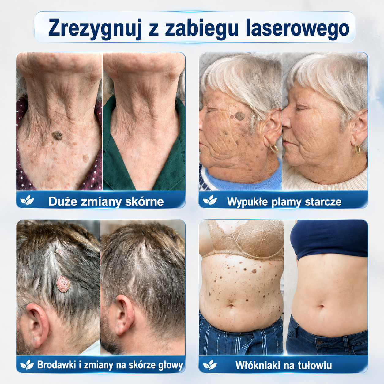 𝐎𝐟𝐢𝐜𝐣𝐚𝐥𝐧𝐲 𝐒𝐤𝐥𝐞𝐩 𝐌𝐚𝐫𝐤𝐢 | 🧿 𝐏i𝐜𝐝o® 7-dniowy roller do pielęgnacji włókniaków i plamek skórnych — bez bólu, bez blizn 🌀