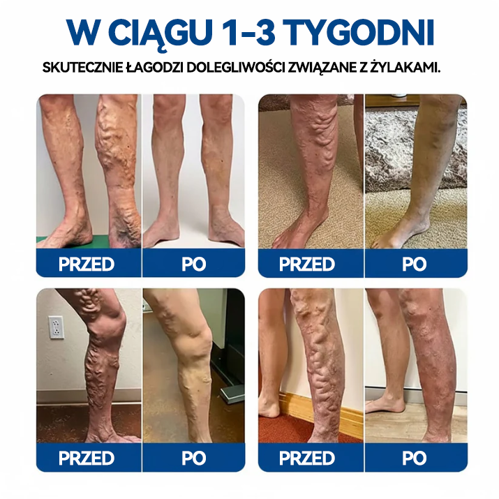 🎁 Zostało już tylko 5 opakowań! Teraz możesz otrzymać dodatkowe 50% ZNIŻKI! 🎉🇵🇱👨‍⚕️✅TAILEDEN® VeinEase Plastry z Mikronakłuciami⚡Natychmiastowa ulga, długotrwałe rezultaty
