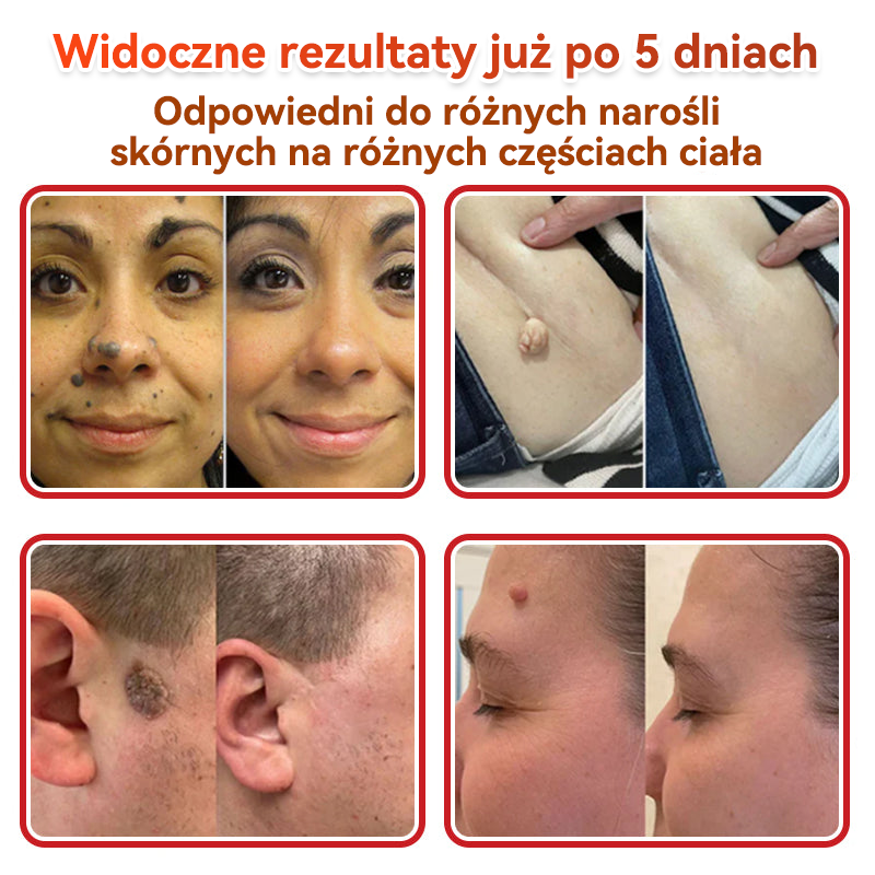 ✅ GFOUK® Plastry do usuwania brodawek i znamion z mikronakłuciami roślinnymi