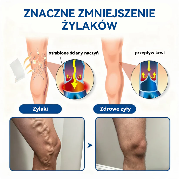 🎁 Zostało już tylko 5 opakowań! Teraz możesz otrzymać dodatkowe 50% ZNIŻKI! 🎉🇵🇱👨‍⚕️✅TAILEDEN® VeinEase Plastry z Mikronakłuciami⚡Natychmiastowa ulga, długotrwałe rezultaty