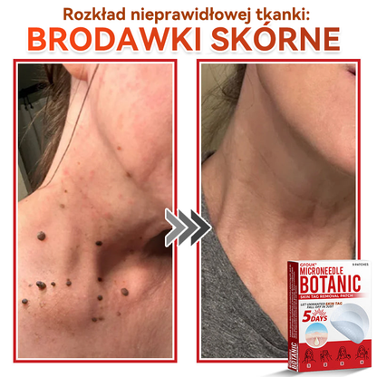 ✅ GFOUK® Plastry do usuwania brodawek i znamion z mikronakłuciami roślinnymi