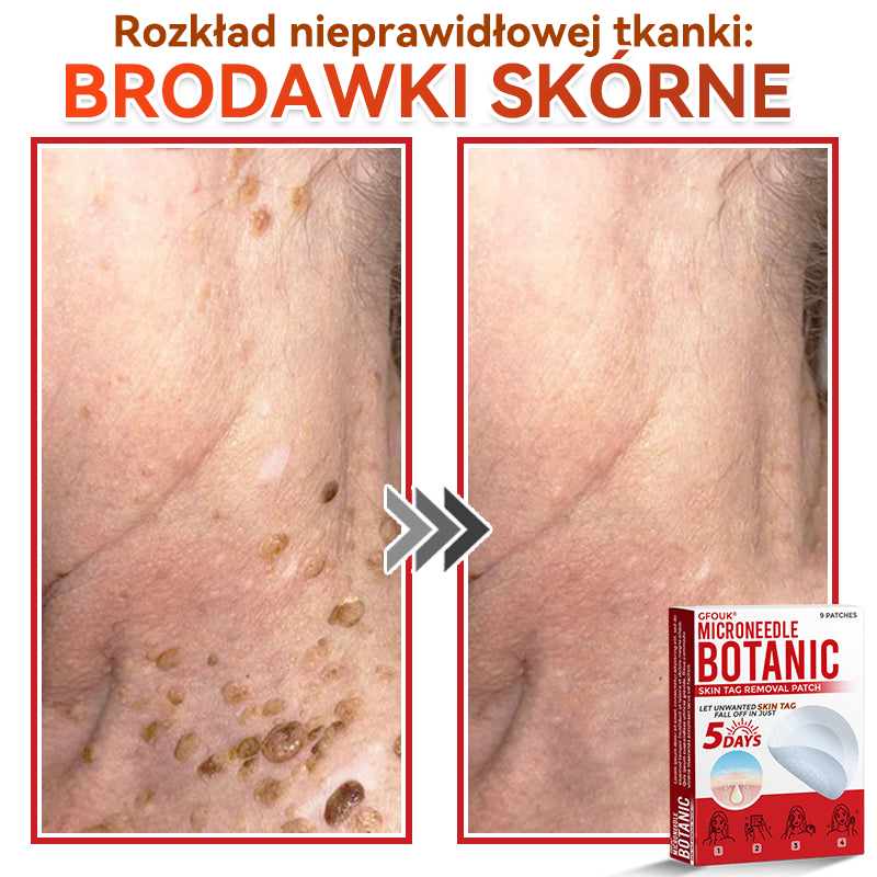 🎁 Zostało już tylko 5 opakowań! Teraz możesz otrzymać dodatkowe 50% ZNIŻKI!  Pomaga widocznie zmniejszyć włókniaki, brodawki i inne niedoskonałości skóry — szybko, wygodnie i bez bólu. 🌿