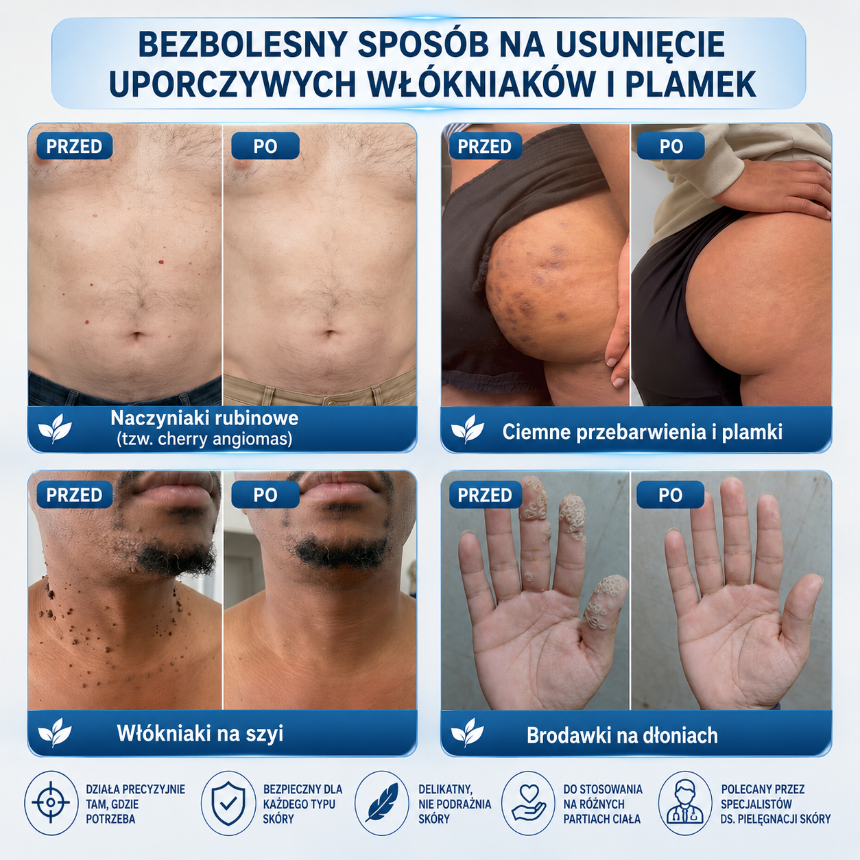 𝐎𝐟𝐢𝐜𝐣𝐚𝐥𝐧𝐲 𝐒𝐤𝐥𝐞𝐩 𝐌𝐚𝐫𝐤𝐢 | 🧿 𝐏i𝐜𝐝o® 7-dniowy roller do pielęgnacji włókniaków i plamek skórnych — bez bólu, bez blizn 🌀