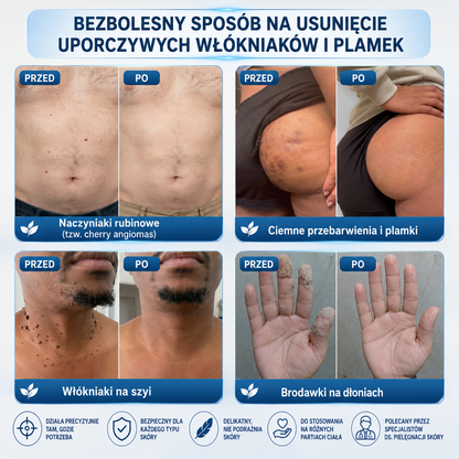 𝐎𝐟𝐢𝐜𝐣𝐚𝐥𝐧𝐲 𝐒𝐤𝐥𝐞𝐩 𝐌𝐚𝐫𝐤𝐢 | 🧿 𝐏i𝐜𝐝o® 7-dniowy roller do pielęgnacji włókniaków i plamek skórnych — bez bólu, bez blizn 🌀